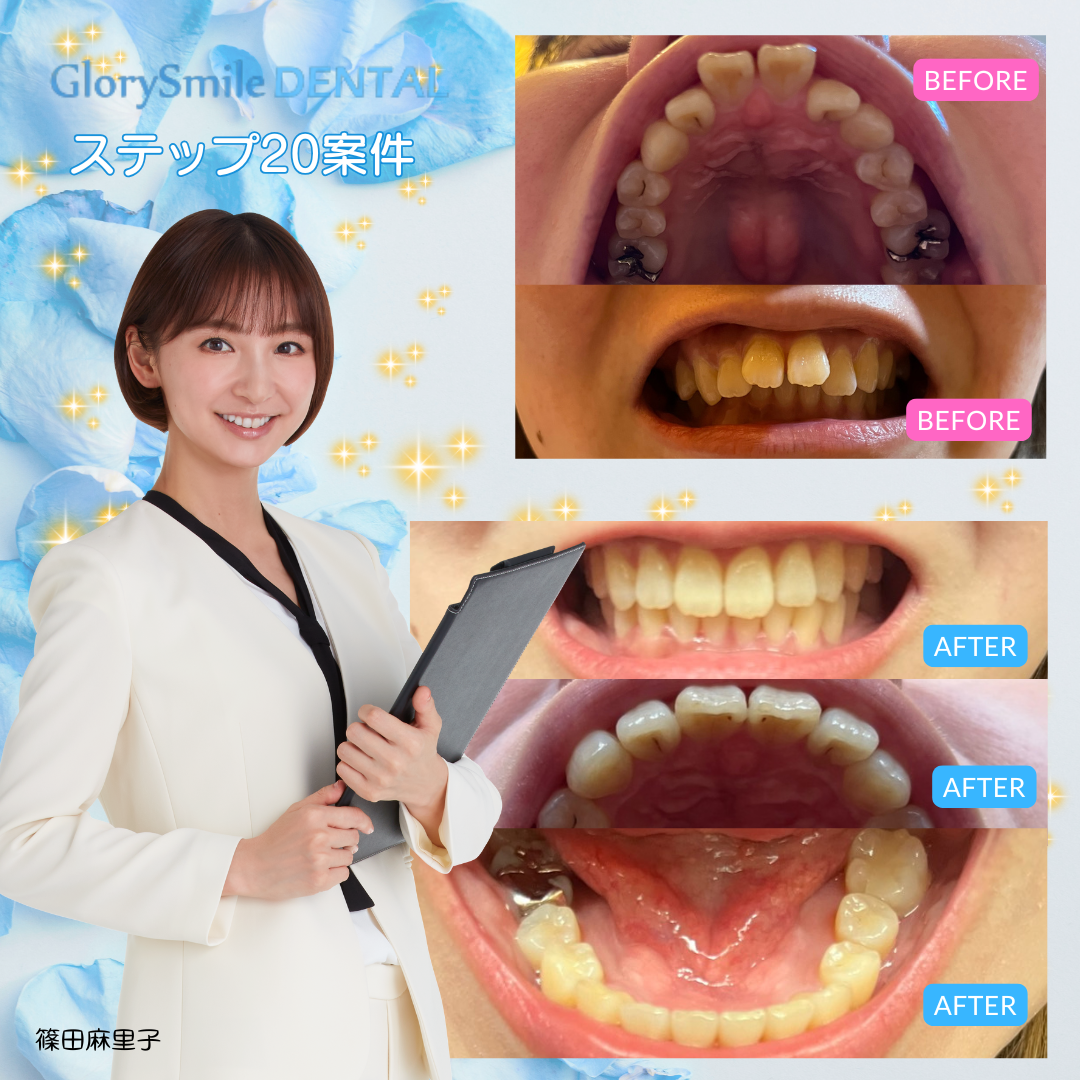 BeforeAfter 2