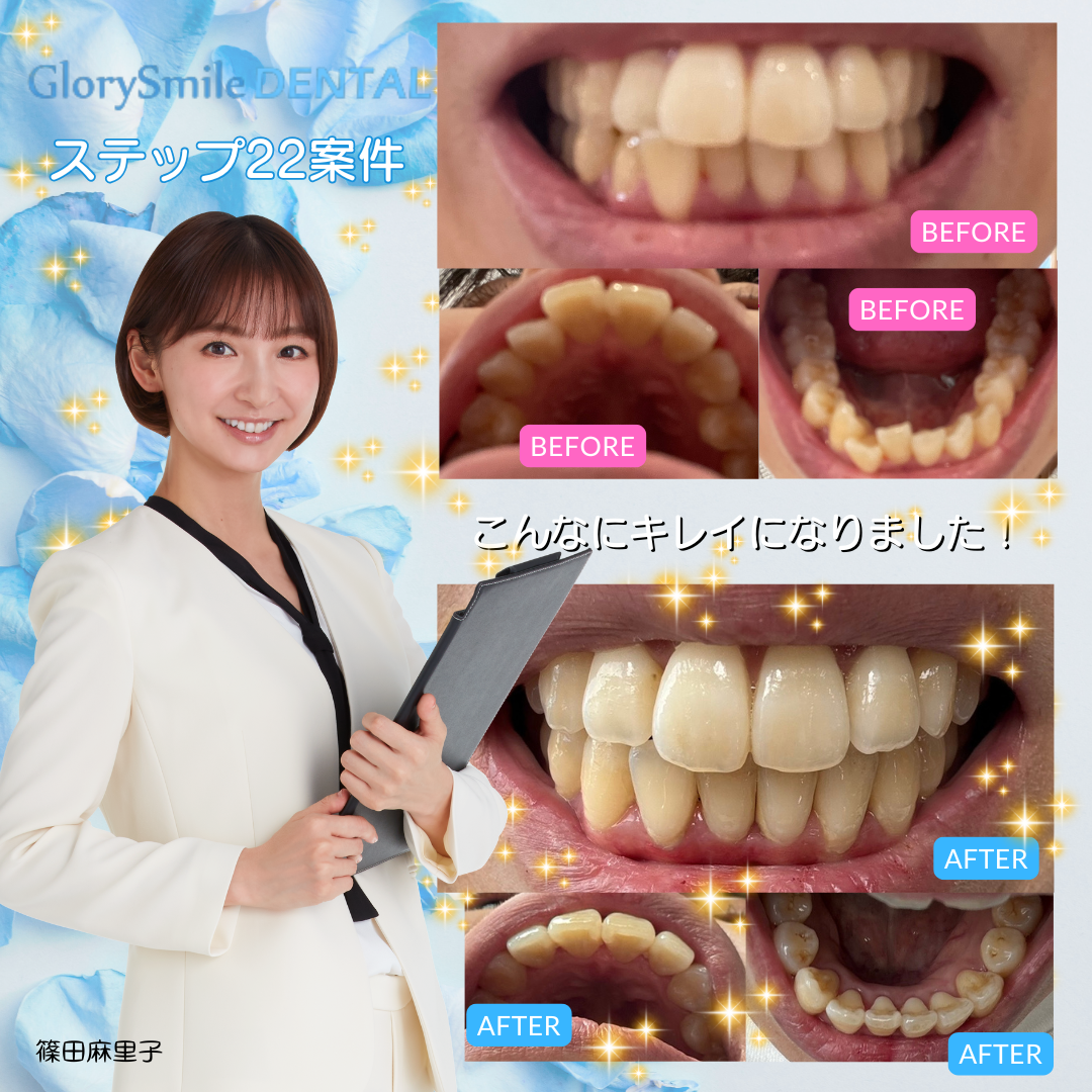 BeforeAfter 3