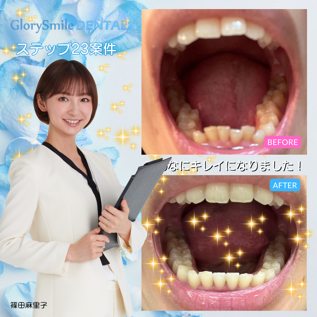 BeforeAfter 4