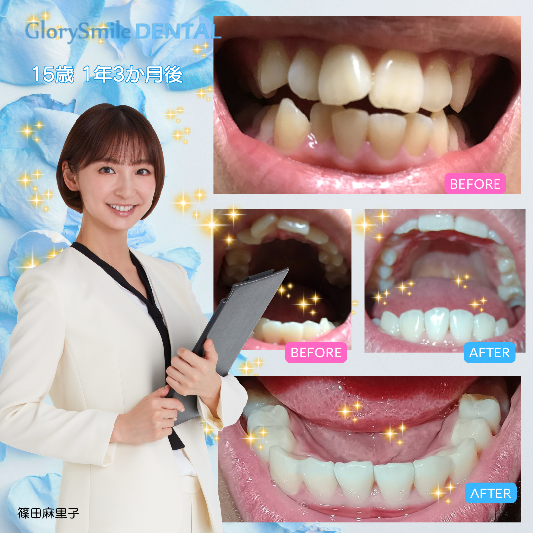 BeforeAfter 6
